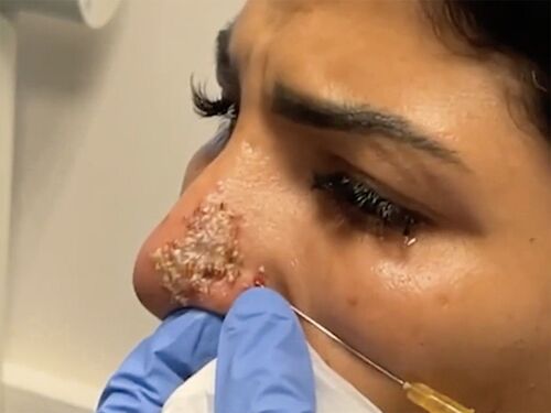 « Fake-injectors » : exercice illégal de la médecine